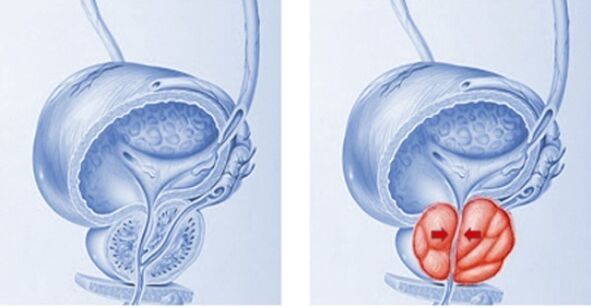 the prostate is healthy and becomes inflamed with prostatitis